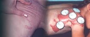 Tratamientos Estéticos con Biofotonterapia (Filtros Bioluminis)
