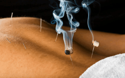 La Moxibustión y sus beneficios